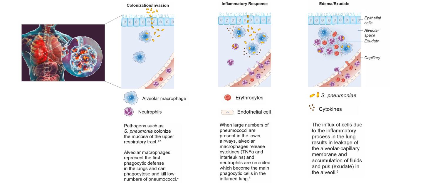 CAP Pathogenesis