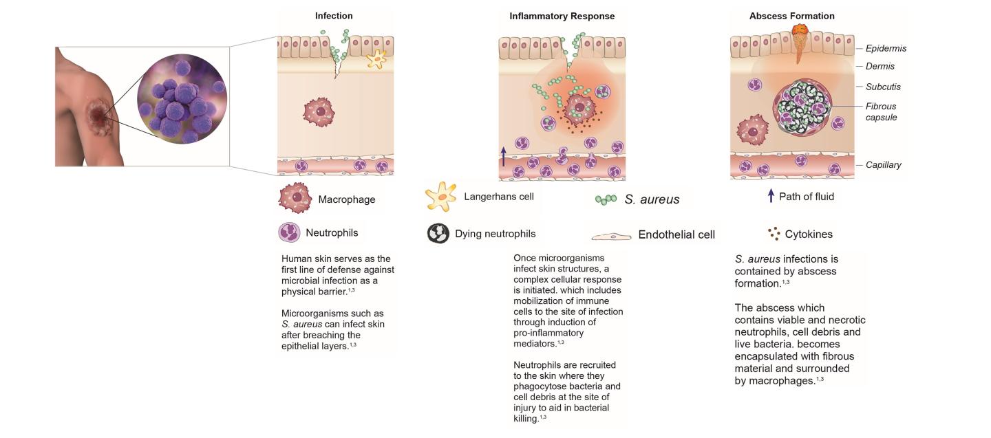 SSTI pathogenesis