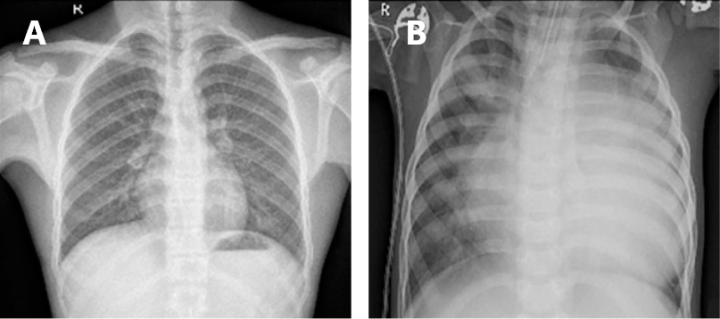 Chest X rays